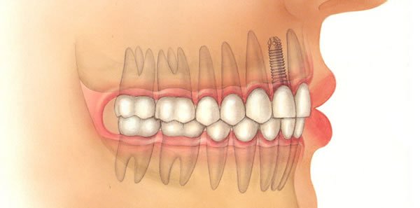 Implantologia dentale